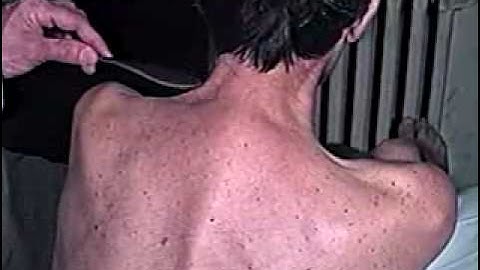 Abnormal Cranial Nerve Exam : Cranial Nerve 11- Motor