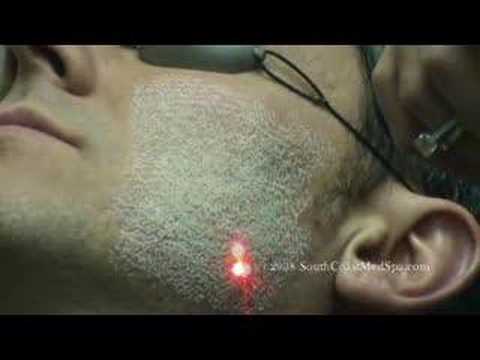 Laser Skin Resurfacing for Acne Scar Removal