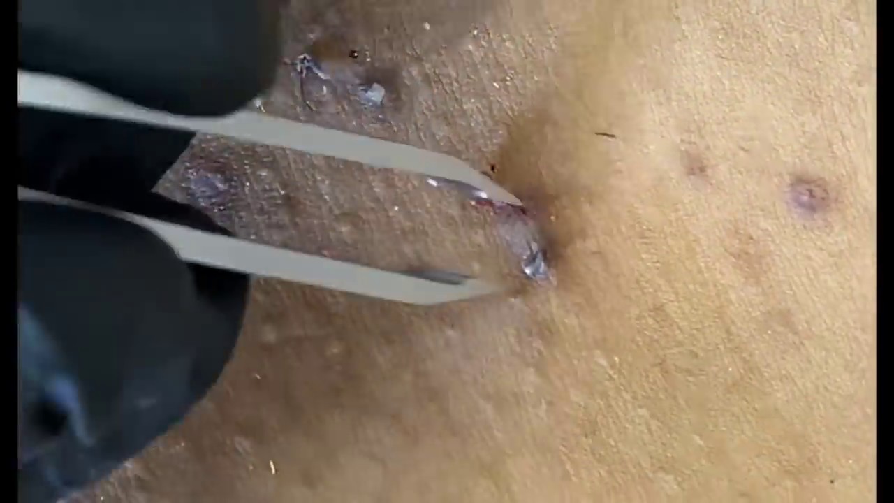 Blackhead extraction