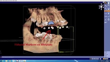 Sicat Classic Guide Direct Radiographic Template with Bite Registration