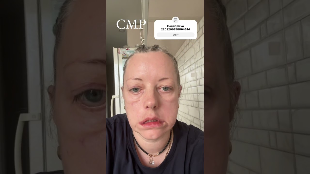 Синдром Мелькерссона-Розенталя – это редкое хроническое заболевание невыясненной природы. #леночек