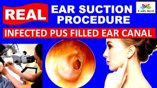 Ruptured Eardrum suction procedure | Ear professionally cleaned - and the results shocked us.