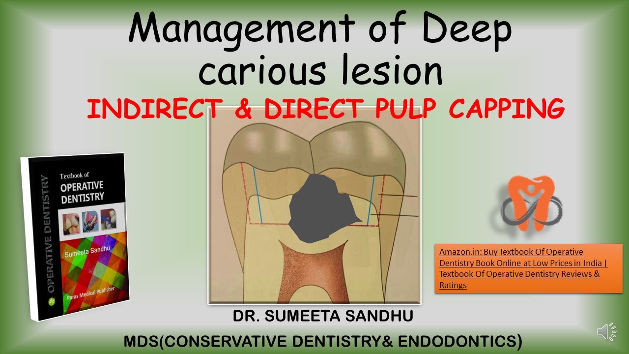 Management Of Deep Caries Pulp Capping Procedures Indirect And Direct Management Of Deep Caries Pulp Capping Procedures Indirect And Direct