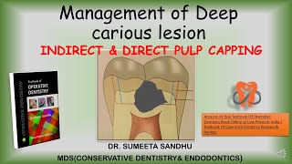 Management of deep caries| Pulp capping procedures| Indirect and Direct pulp capping