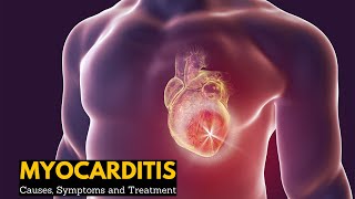 Myocarditis, Causes, Signs and Symptoms, Diagnosis, Treatment