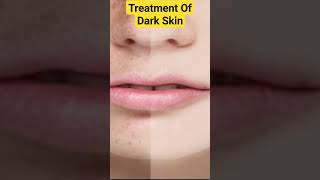Treatment Of Dark Skin-fairness-dark spot-melasma treatment-chhaiskinshineshortvideoyoutubeshorts