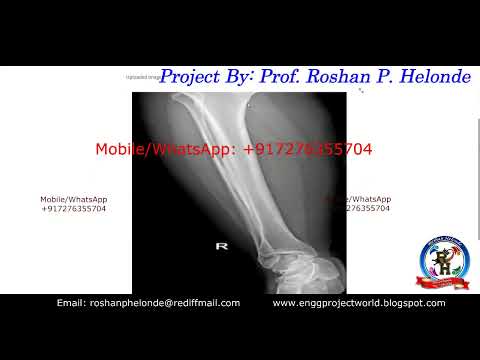 Bone Fracture Detection Using Python Opencv | Bone Fracture Detection Using Deep Learning Project
