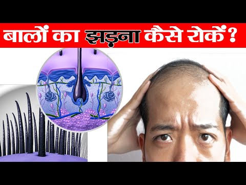 वीडियो: पुरुष पैटर्न बालों के झड़ने का इलाज करने के 12 तरीके