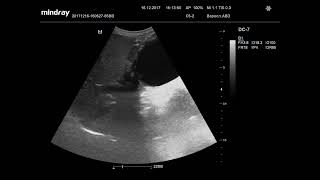 видео: Ультразвуковая диагностика. Доктор Иогансен. Видеопримеры. Выпуск 5. Киста поджелудочной железы. картинка: Ультразвуковая диагностика. Доктор Иогансен. Видеопримеры. Выпуск 5. Киста поджелудочной железы.