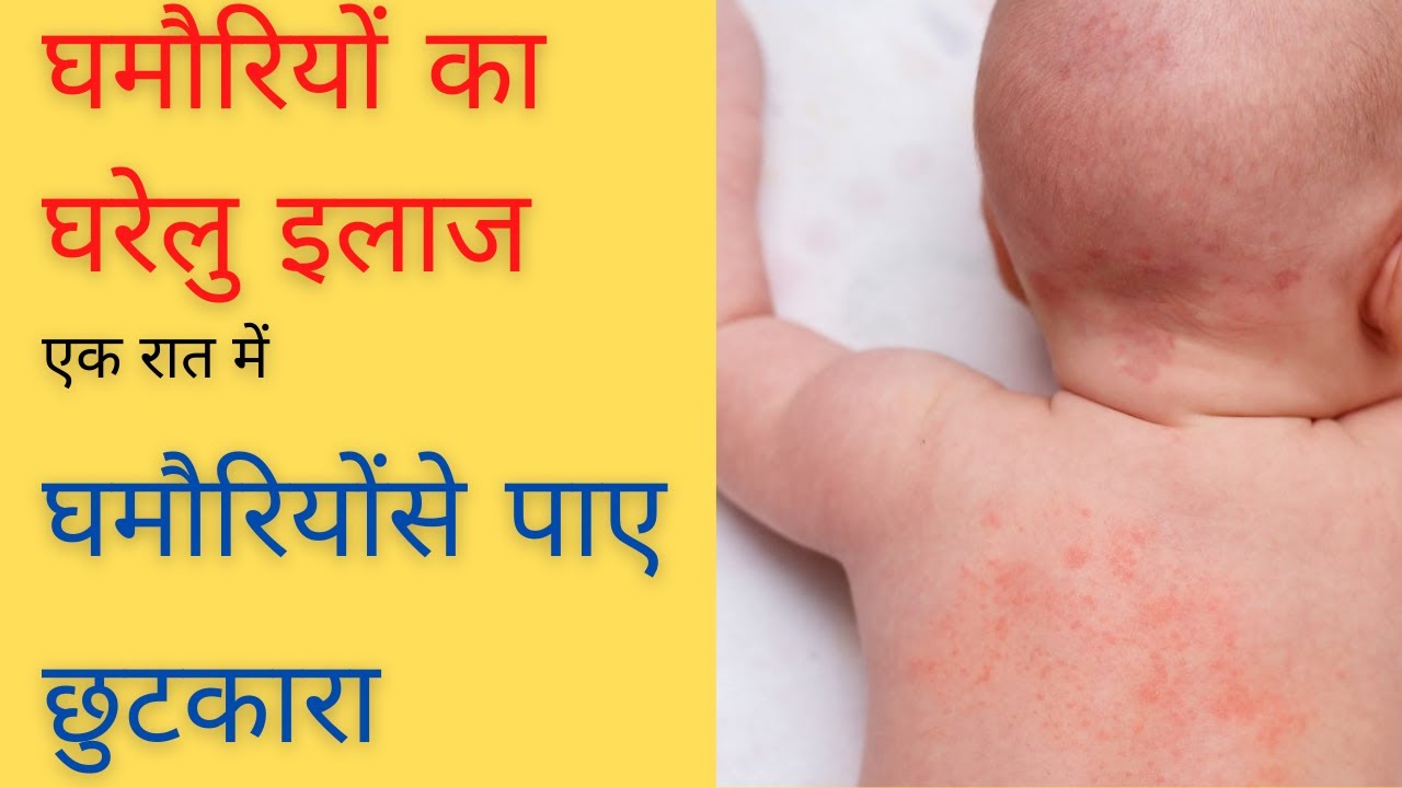 Prickly Heat Rashes Sweat Rashes Ghamoriya ka ilaj Ghamoriyon ko