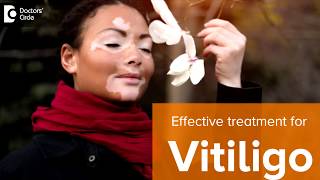 What is vitiligo? Laser treatment for vitiligo - Dr Rajdeep Mysore | Doctors