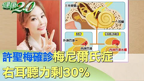 许圣梅眩晕.呕吐确诊梅尼尔氏症 右耳听力剩30% 健康2.0 - 天天要闻