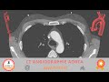  anatomie in der ct angiographie der thorakalen und abdominellen aorta