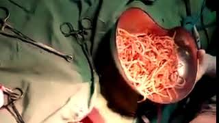 Ascaris Lumbricodes | Urdu |Hindi| |English | How To Remove Worm By operation Complete Video.....