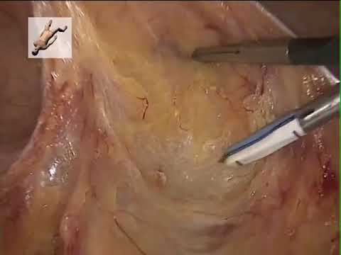 Lap Mesorectal Excision tips