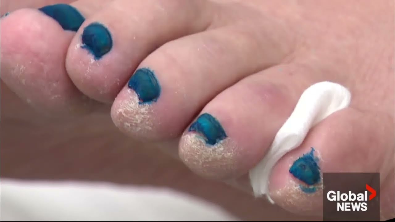 Clearer, Healthier Nails Are Possible with ToeFX – Now Available at Perfect Strides Foot Care