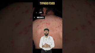 Typhoid Fever Rose Spots