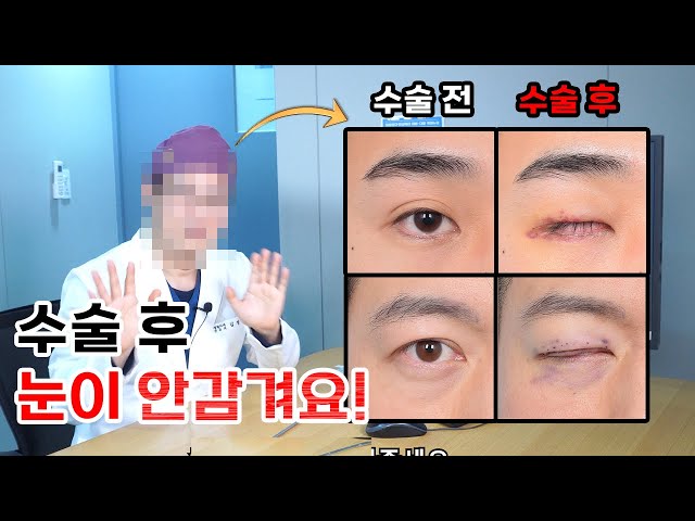 토안을 만드는 의사라구요?? │ 쌍꺼풀없애기 수술 후 생기는 일!