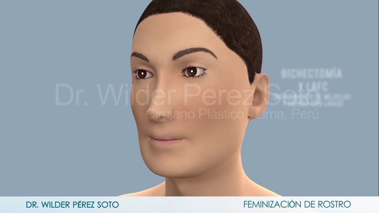 FEMINIZACION FACIAL LIMA PERU DR.WILDER PEREZ SOTO (MALE TO FEMALE)