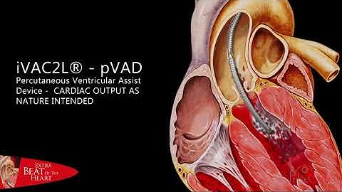 PulseCath iVAC2L -pVAD animation
