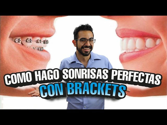 Estrategias para la correcta colocación de brackets protegiendo el arco de  sonrisa