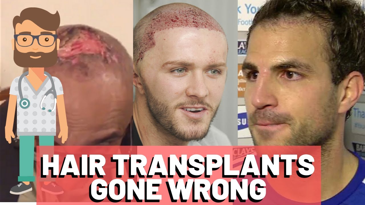 Celebrity Hair Transplant DISASTERS - TOP 3 GONE WRONG - YouTube