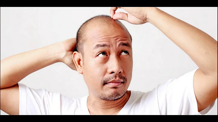 What Are The Different Reasons For  Male Baldness Pattern