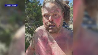 Colorado Man Shares Warning After Suffering Severe Burns In Mechanical Accident