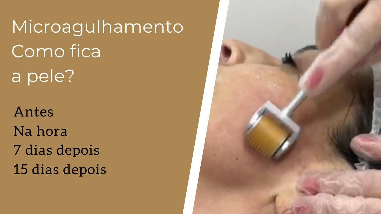 Na menopausa de noturna queima pés