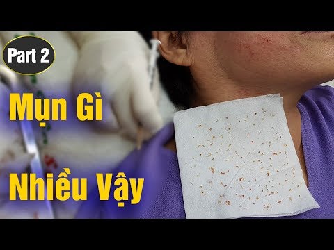 Cách điều trị mụn ẩn - mụn chai lâu năm hiệu quả | Part 2 |. Tại Hiền Vân Spa - 234