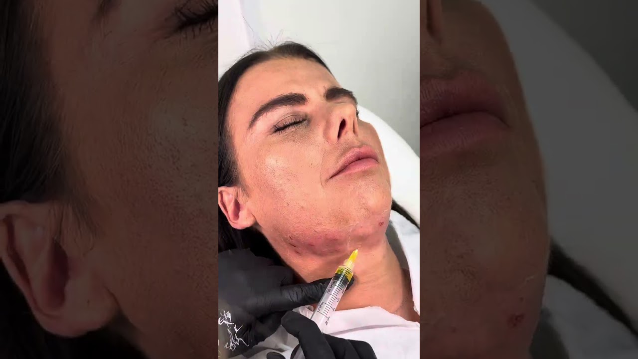 Lemon bottle double chin dissolving tutorial