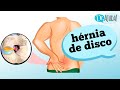 O que é a HÉRNIA DE DISCO? Entenda como ocorre e seus sintomas!