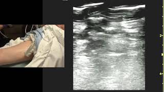 Lower Extremity DVT POCUS