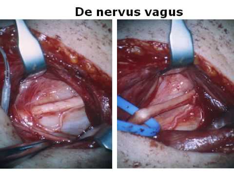 Nervus Vagus Stimulatie Nederlandse uitleg