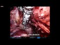 Robot graves total thyroidectomy