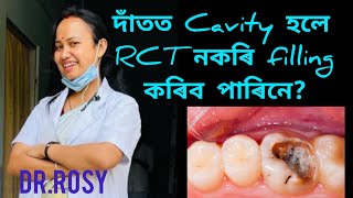 Datot Cavity hole RCT nokorakoi filling koribo pari ne??
