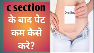 c section ke bad pet kaise kam kare c section after reduce stomch@youtube.saheli @itsDrRyan