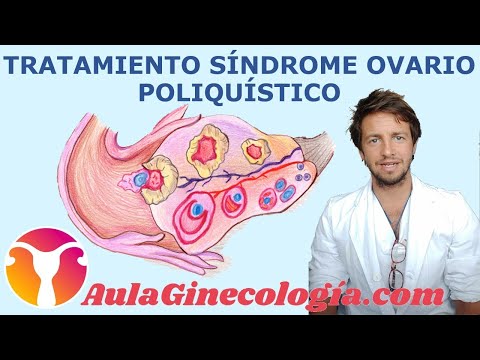 Video: 3 formas sencillas de tomar metformina para el síndrome de ovario poliquístico