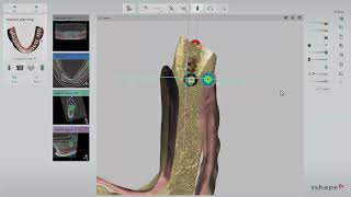 Planning and placing implants for edentulous patients in Implant Studio
