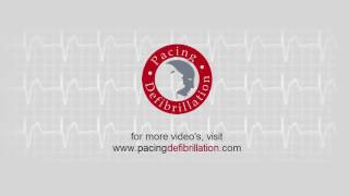 Medtronic ICD | 2. Oversensing | Lead dysfunction 3