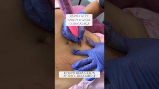 PERMANENT Stretch mark Treatment | camouflage #stretchmarksremoval #skincare