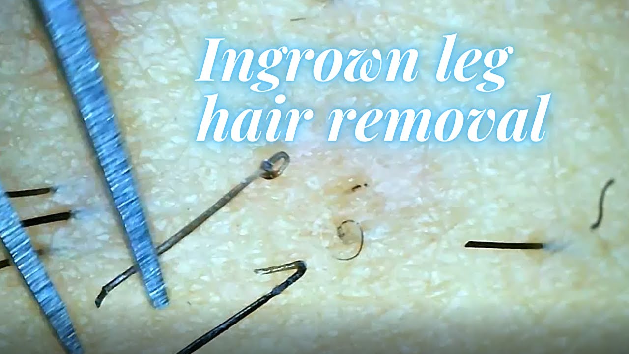 Satisfying leg hair plucking with chill background music YouTube