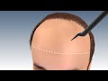 Step by Step FUE Hair Transplant Surgery in jaipur| Hair transplant in india| Outbloom clinics