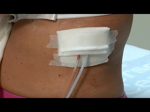 How to care for a post-surgery wound drainage system and gauze dressing