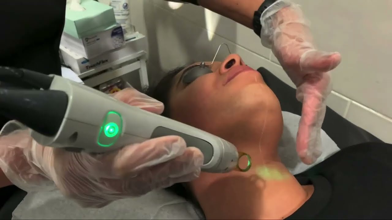 face laser hair removal 1st Session I laser hair removal