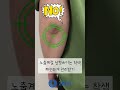 흑꿈치 탈출 #팔꿈치착색 #착색 #색소침착 #토닝 #미백관리