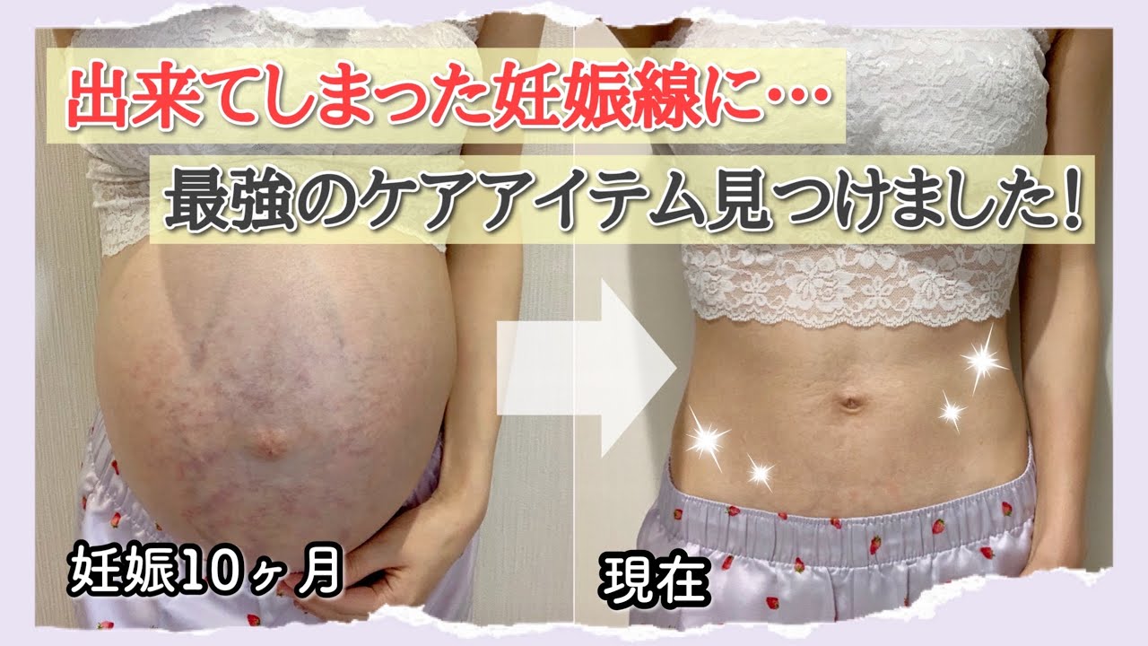 ナイトルーティン 出来てしまった妊娠線は夜の1分ケアで改善します 生後1歳0ヶ月 Youtube