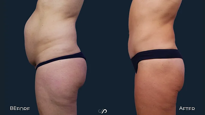 Female Tummy Tuck + Liposuction | Dr. David Stoker...