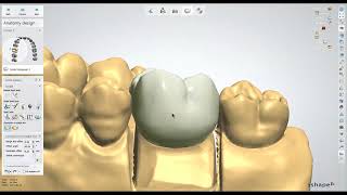 Dental Lab Life: Designing a Crown in 3Shape