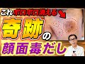 【奇跡の0円美容】顔の毒素を徹底排除!シミ・ホクロ・イボが取れる“顔面毒流し”